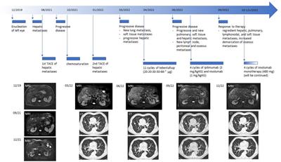 Successful treatment of metastatic uveal melanoma with ipilimumab and nivolumab after severe progression under tebentafusp: a case report